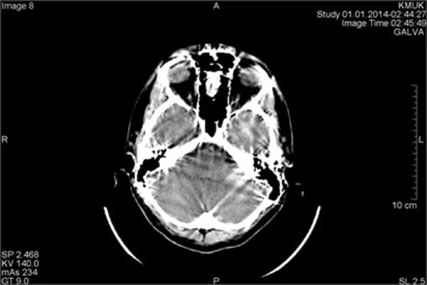 Common Imaging Artifacts (CT & MRI) and How to Troubleshoot Them