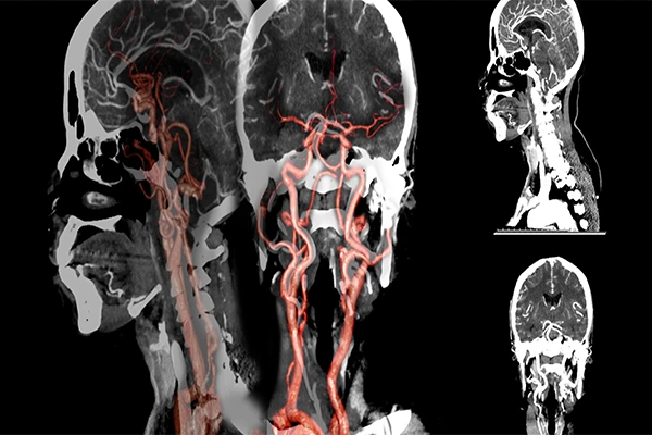 A Guide to CT Angiography (CTA): Visualizing Blood Vessels