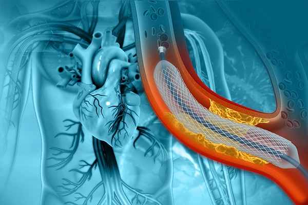 An Introduction to Interventional Radiology: Image-Guided Procedures