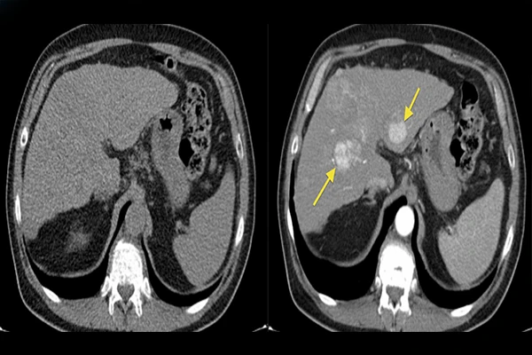 Why Do I Need an IV Contrast for My Scan? (CT & MRI)