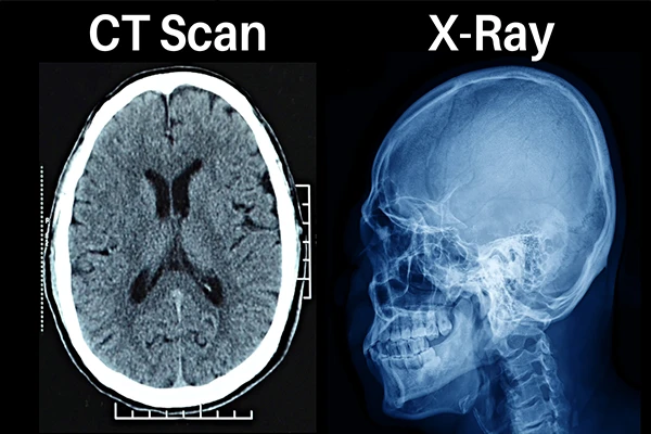 X-ray vs. CT Scan: What’s the Difference?